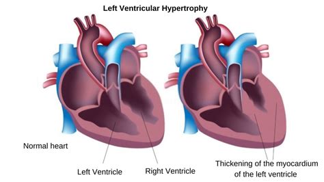 pelliccia lv|Left ventricular hypertrophy in world class elite athletes is .